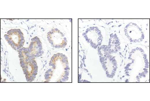 Immunohistochemical analysis of paraffin-embedded human colon carcinoma, using Gα (pan) Antibody in the presence of control peptide (left) or antigen specific peptide (right).