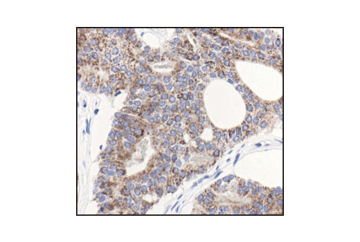 Immunohistochemical analysis of paraffin-embedded human prostate carcinoma using Gα (pan) Antibody.