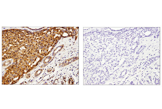 Immunohistochemical analysis of paraffin-embedded human breast carcinoma using Galectin-1/LGALS1 (D608T) Rabbit mAb (IHC Formulated) in the presence of control peptide (left) or antigen specific peptide (right).