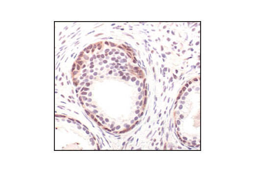 Immunohistochemical analysis of paraffin-embedded human prostate carcinoma using GAPDH (14C10) Rabbit mAb.