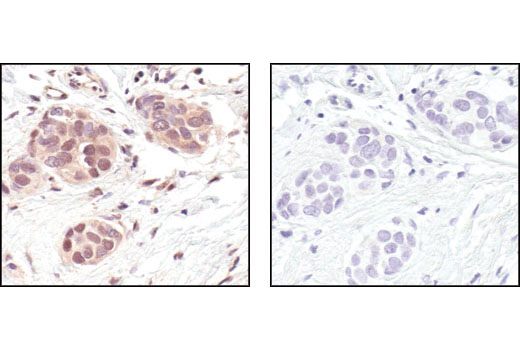 Immunohistochemical analysis of paraffin-embedded human breast carcinoma using GAPDH (14C10) Rabbit mAb in the presence of control peptide (left) or antigen-specific peptide (right).