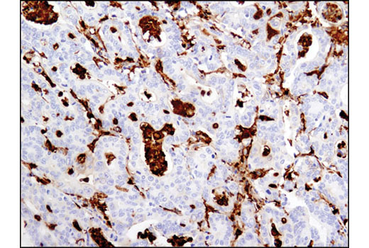 Immunohistochemical analysis of paraffin-embedded human colon carcinoma using Gelsolin (D9W8Y) Rabbit mAb.