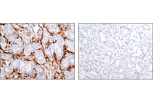 Immunohistochemical analysis of paraffin-embedded human breast carcinoma using Gelsolin (D9W8Y) Rabbit mAb in the presence of control peptide (left) or antigen-specific peptide (right).