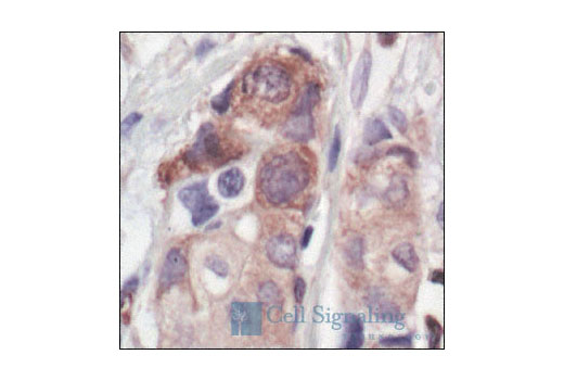 Immunohistochemical analysis of paraffin-embedded human breast carcinoma, showing cytoplasmic localization, using Phospho-Glycogen Synthase (Ser641) Antibody.