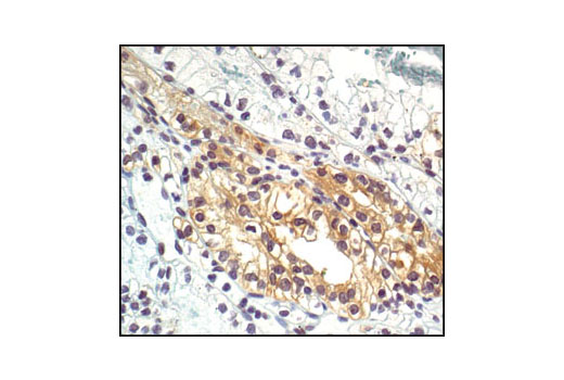 Immunohistochemical analysis of paraffin-embedded renal clear cell adenocarcinoma using Phospho-Glycogen Synthase (Ser641) Antibody.