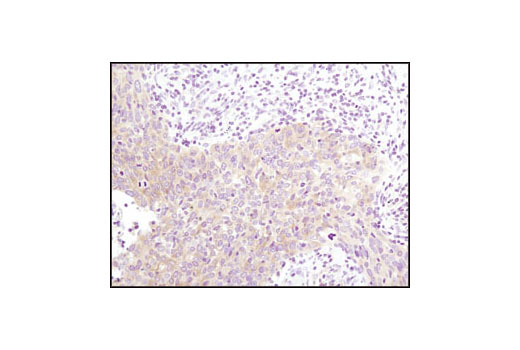 Immunohistochemical analysis of paraffin-embedded human lung carcinoma, using Glycogen Synthase (15B1) Rabbit mAb.