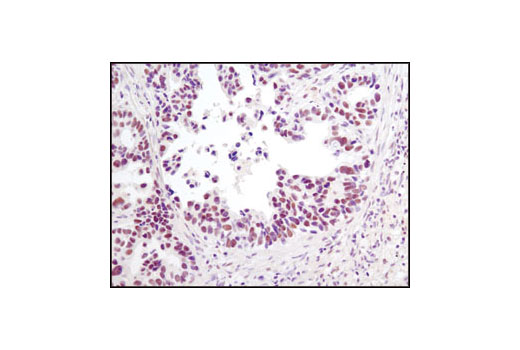 Immunohistochemical analysis of paraffin-embedded human lung carcinoma using Phospho-HDAC3 (Ser424) Antibody.