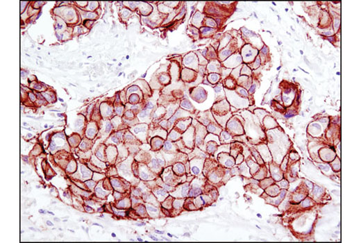 Immunohistochemical analysis of paraffin-embedded human breast carcinoma using HER2/ErbB2 (D8F12) XP ® Rabbit mAb.