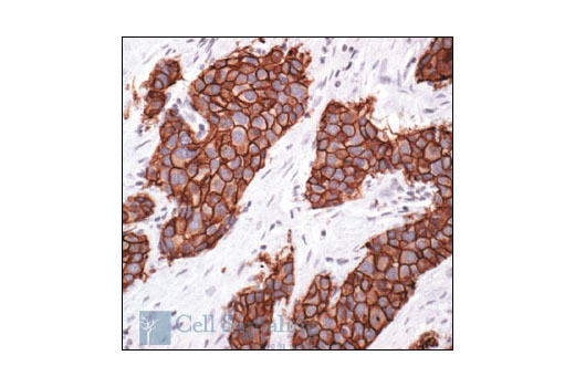 Immunohistochemical analysis of paraffin-embedded human breast carcinoma, showing membrane localization, using HER2/ErbB2 Antibody.