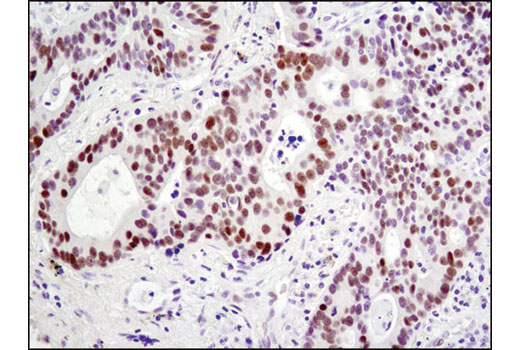 Immunohistochemical analysis of paraffin-embedded human lung carcinoma using HES1 (D6P2U) Rabbit mAb.