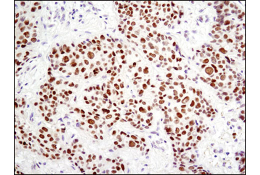 Immunohistochemical analysis of paraffin-embedded human breast carcinoma using HES1 (D6P2U) Rabbit mAb.
