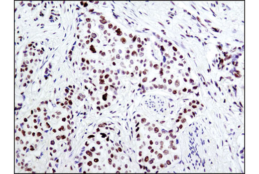 Immunohistochemical analysis of paraffin-embedded human breast carcinoma using Acetyl-Histone H2B (Lys5) (D5H1S) XP ® Rabbit mAb.