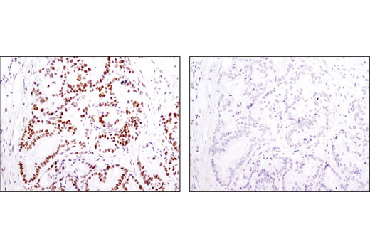 Immunohistochemical analysis of paraffin-embedded human colon carcinoma using Acetyl-Histone H2B (Lys5) (D5H1S) XP ® Rabbit mAb in the presence of non-acetyl peptide (left) or Lys5 acetyl peptide (right).