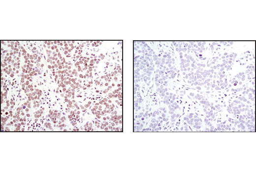 Immunohistochemical analysis of paraffin-embedded human breast carcinoma using Histone H4 (L64C1) Mouse mAb in the presence of control peptide (left) or antigen-specific peptide (right).