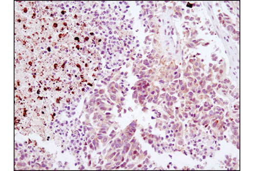 Immunohistochemical analysis of paraffin-embedded human colon carcioma using HMGB1 (D3E5) Rabbit mAb.