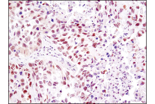 Immunohistochemical analysis of paraffin-embedded human lung carcioma using HMGB1 (D3E5) Rabbit mAb.