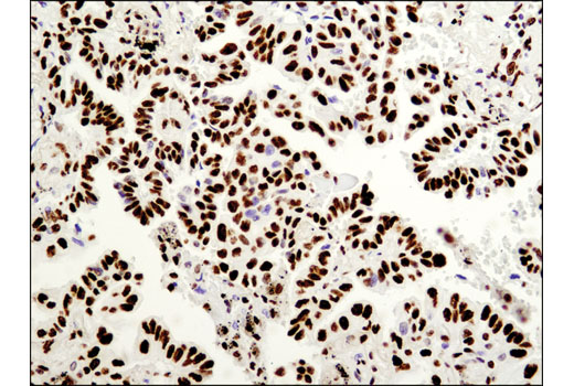 Immunohistochemical analysis of paraffin-embedded human lung carcinoma using AUF1/hnRNP D (D6O4F) Rabbit mAb.