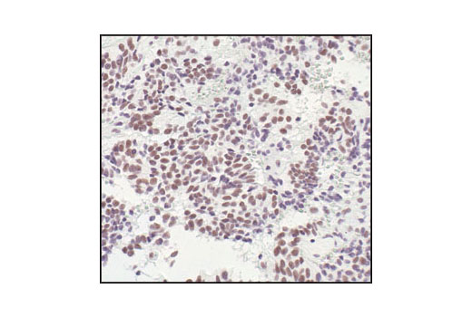 Immunohistochemical analysis of paraffin-embedded human pituitary adenoma, using HSF1 Antibody.