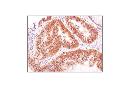 Immunohistochemical analysis of paraffin-embedded human colon carcinoma using HSP40 (C64B4) Rabbit mAb.