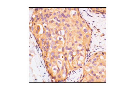 Immunohistochemical analysis of paraffin-embedded human breast tumor section showing membrane and cytoplasmic staining, using IGF-I Receptor b Antibody.