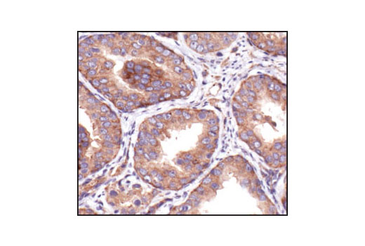 Immunohistochemical analysis of paraffin-embedded human prostate carcinoma using IGF-I Receptor b Antibody.