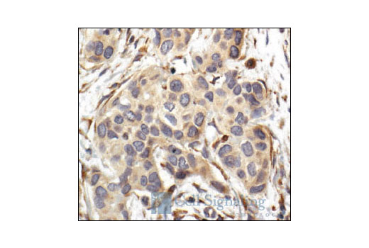 Immunohistochemical analysis of paraffin-embedded human breast carcinoma, showing cytoplasmic localization, using ILK1 Antibody.
