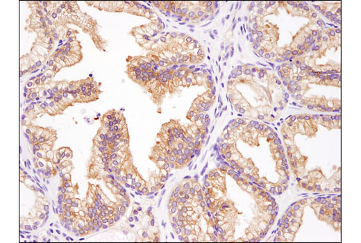 Immunohistochemical analysis of paraffin-embedded human prostate carcinoma using INPP4b (D9K1B) XP ® Rabbit mAb.