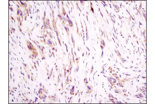 Immunohistochemical analysis of paraffin-embedded human breast carcinoma using Integrin β1 (D2E5) Rabbit mAb.