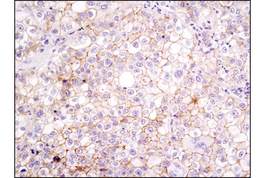 Immunohistochemical analysis of paraffin-embedded human lung carcinoma using Integrin β1 (D2E5) Rabbit mAb.