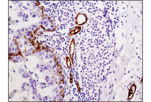 Immunohistochemical analysis of paraffin-embedded human breast carcinoma using Integrin β3 (D7X3P) XP ® Rabbit mAb.