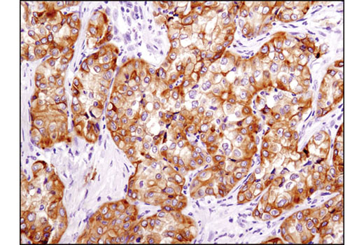 Immunohistochemical analysis of paraffin-embedded human papillary renal cell carcinoma using Integrin β3 (D7X3P) XP ® Rabbit mAb.
