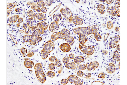 Immunohistochemical analysis of paraffin-embedded human breast carcinoma using Integrin β4 (D8P6C) XP ® Rabbit mAb.