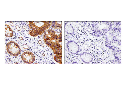 Immunohistochemical analysis of paraffin-embedded human colon carcinoma using Integrin β4 (D8P6C) XP ® Rabbit mAb in the presence of control peptide (left) and antigen-specific peptide (right).