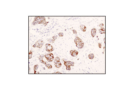Immunohistochemical analysis of paraffin-embedded human breast carcinoma using Jak1 (6G4) Rabbit mAb.
