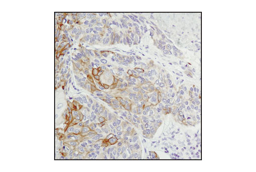 Immunohistochemical analysis of paraffin-embedded human lung carcinoma using Jak1 (6G4) Rabbit mAb.