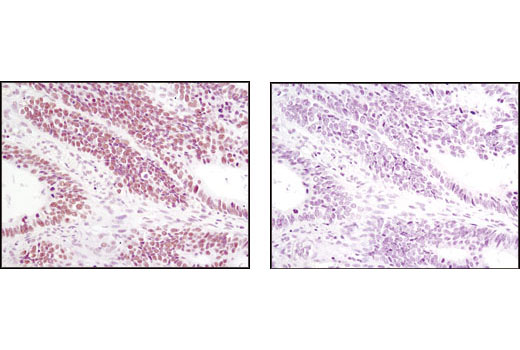 Immunohistochemical analysis of paraffin-embedded human colon carcinoma using JMJD1B (C6D12) Rabbit mAb in the presence of control peptide (left) or antigen-specific peptide (right).