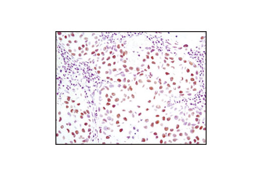 Immunohistochemical analysis of paraffin-embedded human lung carcinoma using JMJD1B (C6D12) Rabbit mAb.