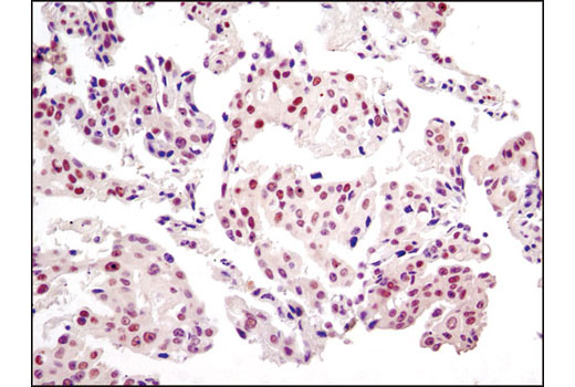 Immunohistochemical analysis of paraffin-embedded human lung carcinoma using JMJD2A (C37E5) Rabbit mAb.