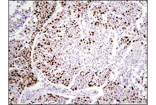 Immunohistochemical analysis of paraffin-embedded human breast carcinoma using Ki-67 (D2H10) Rabbit mAb (IHC Specific).
