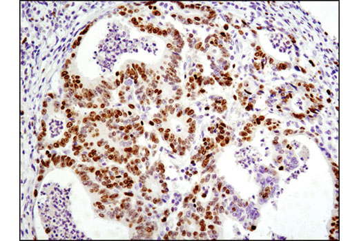 Immunohistochemical analysis of paraffin-embedded human colon carcinoma using Ki-67 (D2H10) Rabbit mAb (IHC Specific).