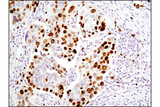 Immunohistochemical analysis of paraffin-embedded human ovarian serous adenocarcinoma using Ki-67 (D2H10) Rabbit mAb (IHC Specific).