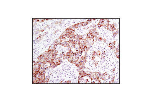 Immunohistochemical analysis of paraffin-embedded human breast carcinoma using Keratin 17/19 (D32D9) XP ® Rabbit mAb.