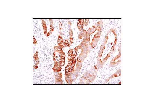 Immunohistochemical analysis of paraffin-embedded human colon carcinoma using Keratin 17/19 (D32D9) XP ® Rabbit mAb.