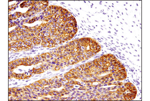 Immunohistochemical analysis of paraffin-embedded human ovarian carcinoma using Keratin 17/19 (D4G2) XP ® Rabbit mAb.