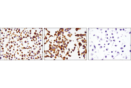 Immunohistochemical analysis of paraffin-embedded keratin 17 positive HeLa cells (left), keratin 19 positive HCC827 cells (middle), and keratin 17/19 negative SK-MEL-28 cells (right), using Keratin 17/19 (D4G2) XP ® Rabbit mAb.