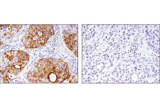 Immunohistochemical analysis of paraffin-embedded human lung squamous cell carcinoma using Keratin 17/19 (D4G2) XP ® Rabbit mAb in the presence of control peptide (left) or antigen-specific peptide (right).