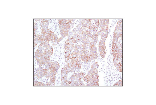 Immunhistochemical analysis of paraffin-embedded human breast carcinoma using Keratin 19 (BA17) Mouse mAb.