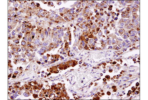 Immunohistochemical analysis of human lung carcinoma using LAMP1 (D2D11) XP(R) Rabbit mAb.