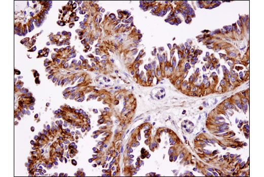 Immunohistochemical analysis of human ovarian serous cystadenoma using LAMP1 (D2D11) XP(R) Rabbit mAb.