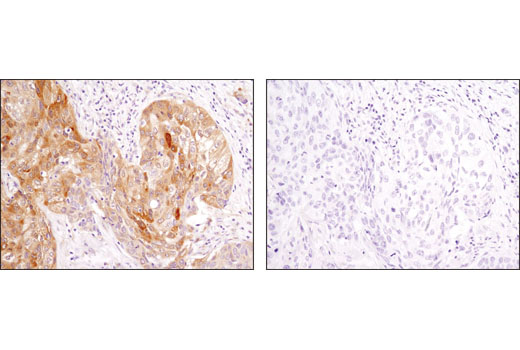 Immunohistochemical analysis of paraffin-embedded human lung carcinoma using LC3A/B (D3U4C) XP® Rabbit mAb in the presence of control peptide (left) or antigen-specific peptide (right).